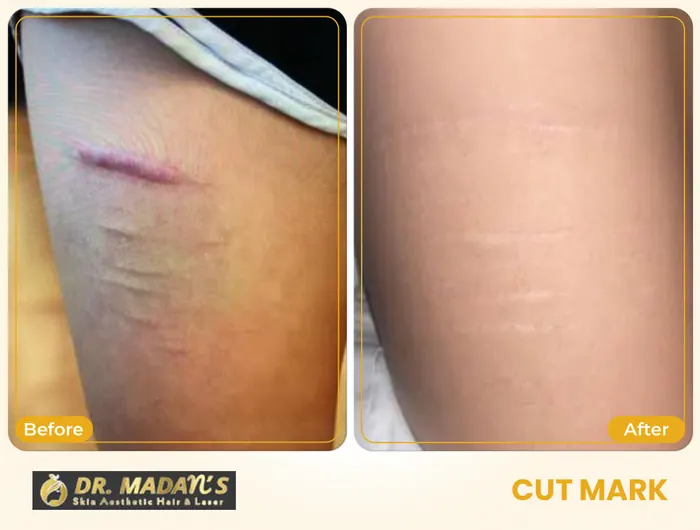 Cut mark before and after result 2 at Dr Madan Aesthetics